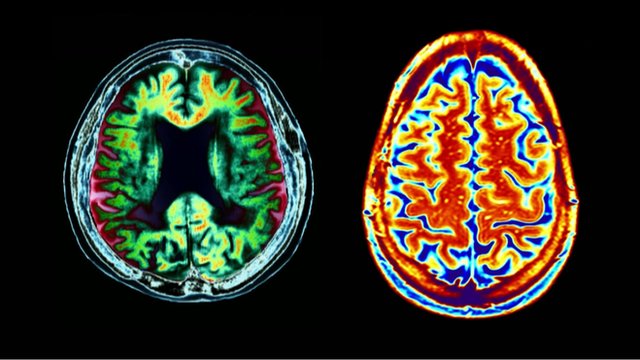 Cérebro com Alzheimer (à direita): sistema ajuda a preservar a memória (Foto: Divulgação)
