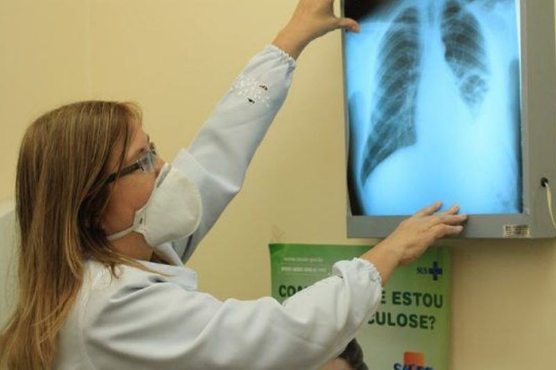 Laudo de Raio-X de pessoa com tuberculose (Foto: Eduardo Gomes/ILMD- Fiocruz Amazônia)