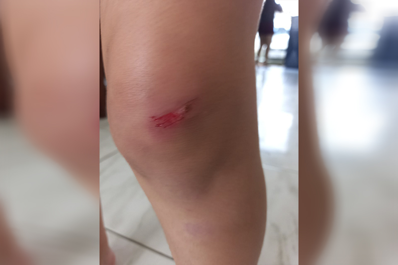 Criança arranhou o joelho ao cair do ônibus (Foto: Patrícia Mirna/Divulgação)