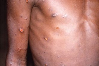 A FVS alerta os sinais como tosse, febre, dor muscular, caroços no pescoço, manchas na face, na palma da mão e planta dos pés (Foto: CDC/Brian W.J. Mahy/ABr)