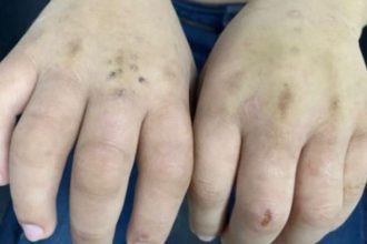 A professora percebeu que o menino não conseguia segurar o lápis para fazer a tarefa e viu que suas mãos estavam inchadas (Foto: Reprodução/Facebook)