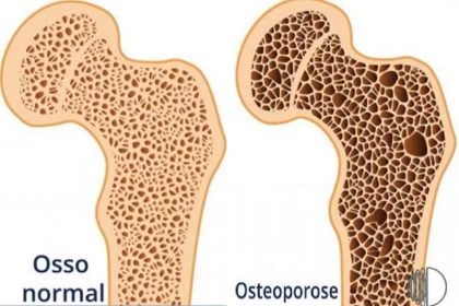 Silenciosa e sem cura, osteoporose provoca 200 mil mortes por ano no Brasil (Foto: Reprodução/Globoplay)