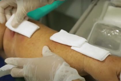Esporotricose causa lesões na pele (Foto: YouTube/Reprodução)