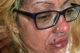 Shafia Bashir mostrou rosto queimado no Twitter após ovo explodir (Foto: Twitter/Reprodução)