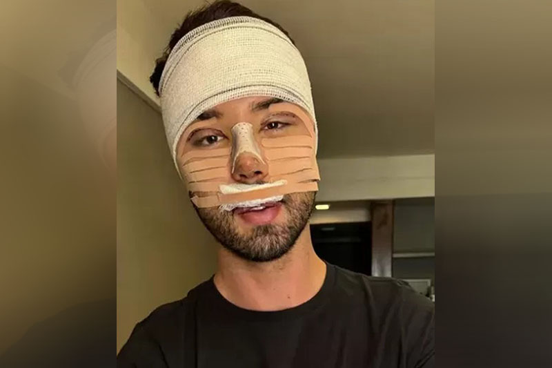 Rico Melquiades com o rosto cheio de badanas: cirurgias plásticas (Foto: Instagram/Reprodução)