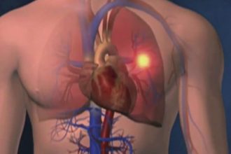 A trombose pode causar embolia pulmonar (Imagem: YouTube/Reprodução)