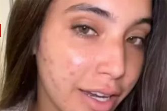 Vanessa Lopes e o rosto com acne; problema de pele (Imagem: Instagram)