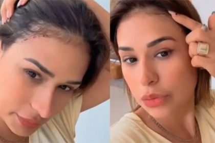 Cantora Simone Mendes mostra cicatriz do procedimento estético (Imagem: Instagram/@simone mendes)