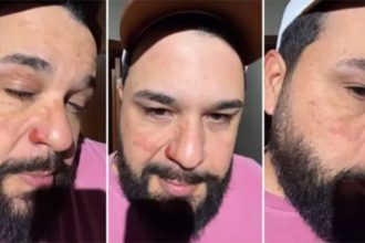 Cantor Léo mostrou marcas deixadas pelo fogo no rosto (Fotos: Instagram/Reprodução)