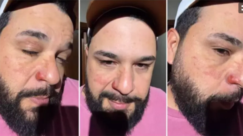Cantor Léo mostrou marcas deixadas pelo fogo no rosto (Fotos: Instagram/Reprodução)