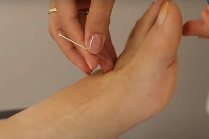 Lei torna a acupuntura profissão da medicina no Brasil (Imagem: YouTube/Reprodução)