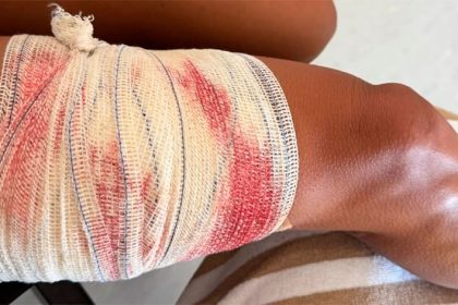 Turista mordida por tubarão