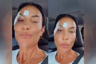 Cantora Ivete Sangalo com curativos no rosto em vídeo no Instagram: alta hospitalar (Imagem: Instagram/Reprodução)