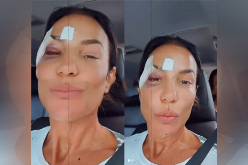 Cantora Ivete Sangalo com curativos no rosto em vídeo no Instagram: alta hospitalar (Imagem: Instagram/Reprodução)